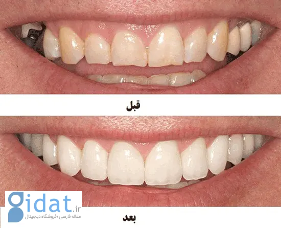 اصلاح طرح لبخند با کامپوزیت + مزایا و معایب